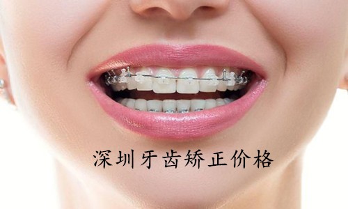 2023深圳正畸价格表公布，来康康矫正牙齿多少钱