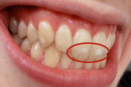 牙齿上有白斑是什么原因？白斑自己会消吗？