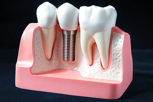 种牙3年就坏了 原来种植牙的质量这么差？