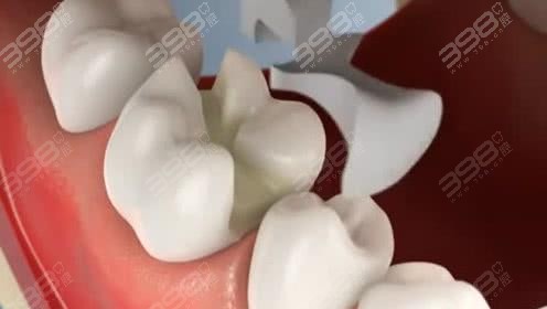 补牙和嵌体的区别是什么