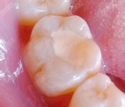 3m树脂补牙和普通树脂的区别