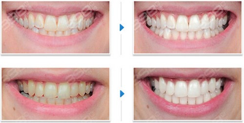 牙齿黄怎么快速变白？