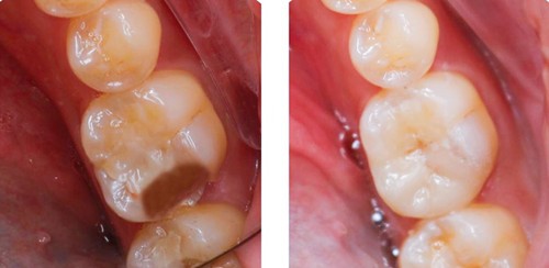 看嵌体补牙和树脂补牙的区别详解,就知道嵌体有必要做吗?