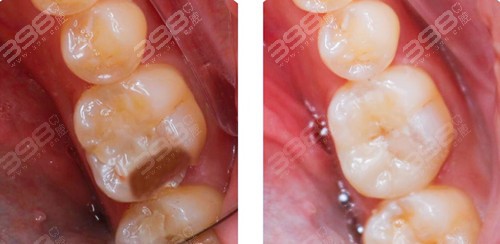 嵌体补牙能维持多久？