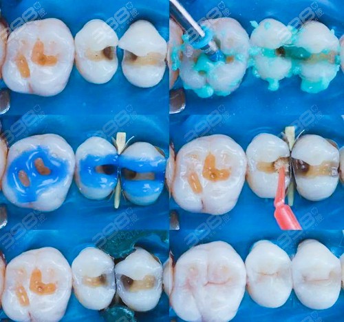嵌体补牙和树脂补牙的区别