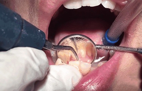 洗牙对牙齿有伤害吗？为什么有人洗完牙齿松动了？