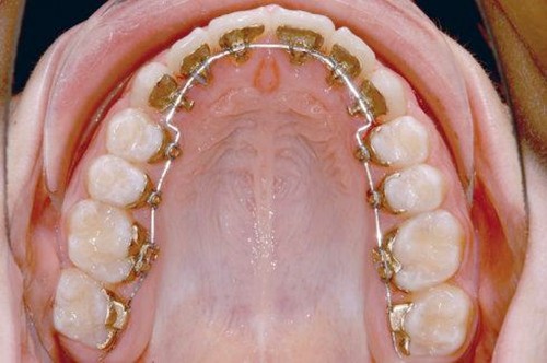 2021牙齿矫正价目表更新至2022,各种牙套的种类和价格都有