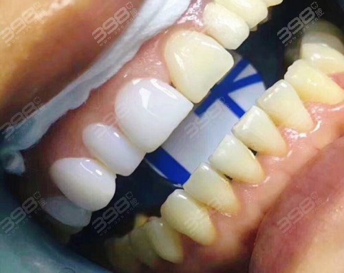 牙齿贴片会不会变成龅牙?超薄全瓷牙贴面效果能好吗?