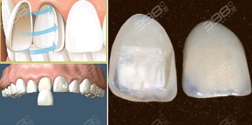 牙齿贴片会不会变成龅牙？