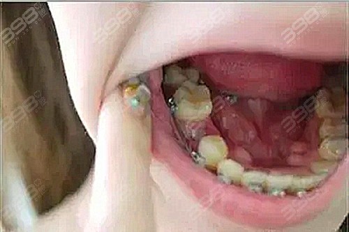牙齿矫正要拔牙有风险吗
