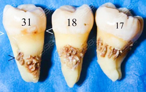 牙周袋深度三级分类自行治疗不可取具体治疗方案看这里