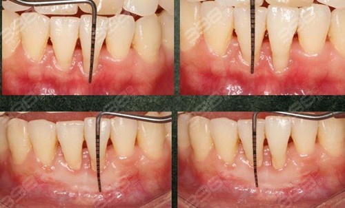 牙周袋深度三级分类:自行治疗不可取,具体治疗方案看这里!