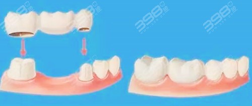 牙齿缺失修复方法-固定义齿