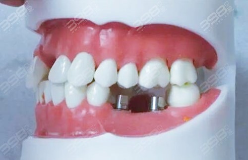 牙齿缺失修复方法-种植牙