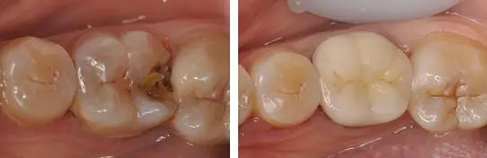 牙冠和嵌体的使用寿命大PK