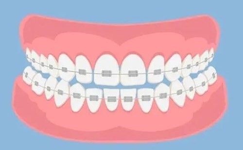 毕节矫正牙齿多少钱？在毕节三千多能矫正牙齿吗？