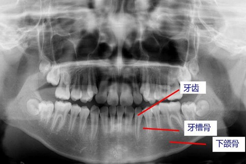 种牙牙槽骨的标准条件是什么？种植牙对牙槽骨又有什么要求呢？