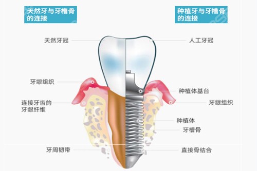 广州正规种牙一颗需要多少钱？