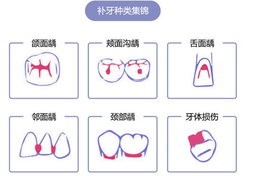 广州牙科医院补牙多少钱一颗？快来看广州补牙收费标准是啥？