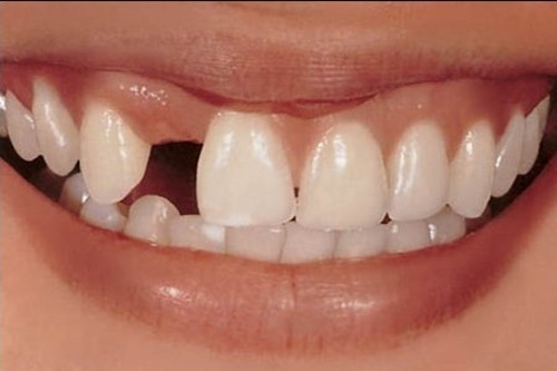 种植牙期间牙空着么？可以带临时牙吗？