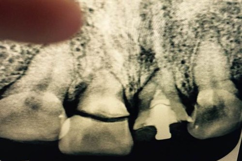门牙断了为什么要做根管治疗？根管治疗后牙齿的寿命有多久？