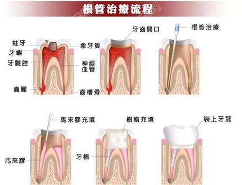 根管治疗后牙齿的寿命有多久？