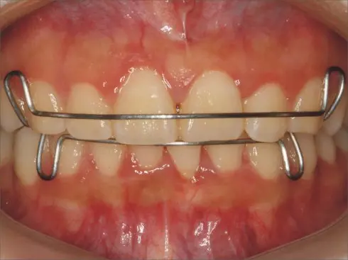 牙齿矫正保持器的重要性