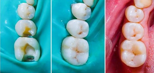 牙齿深龋坏了能补吗?如果蛀牙厉害,深龋可以保髓补牙吗?