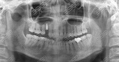 种植牙手术后牙片