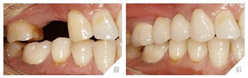 种植牙手术步骤图解，几张图秒懂完整的种植牙过程