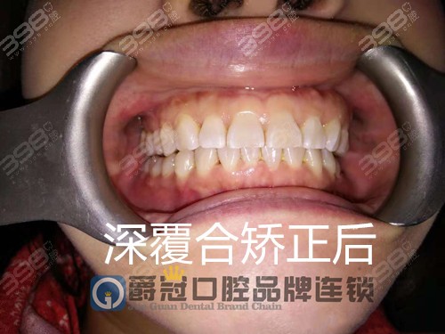 北京牙齿矫正真实经历分享