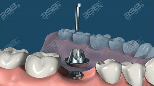 种植牙手术步骤安装基台
