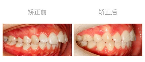中度骨性龅牙正颌矫正对比