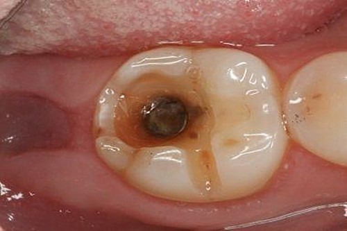 看蛀牙烂到牙神经图片 了解牙齿烂洞长期不补会怎样
