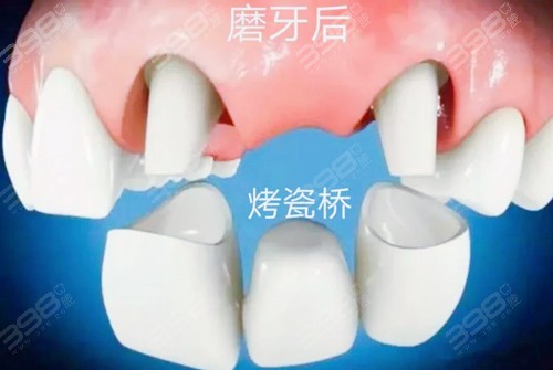 牙齿缺失修复方法-烤瓷桥