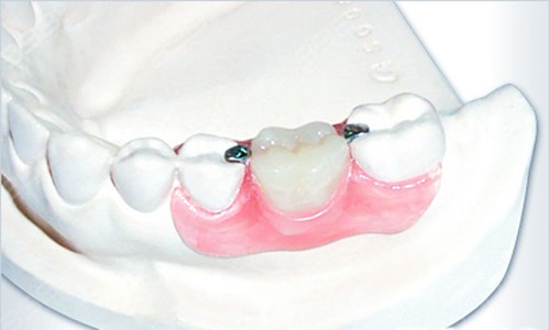 牙齿缺失修复方法-隐形义齿