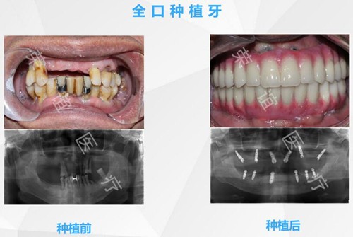 北京全口种植牙好的医院是哪家?荣懿口腔有种牙技术好的医生!