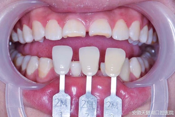 合肥可以做牙瓷贴面的医院:天鹅湖口腔医院帮他恢复健康大白牙