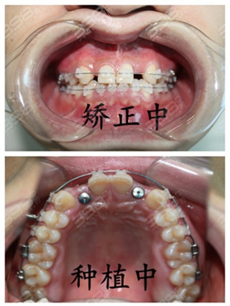 种植牙和正畸联合治疗