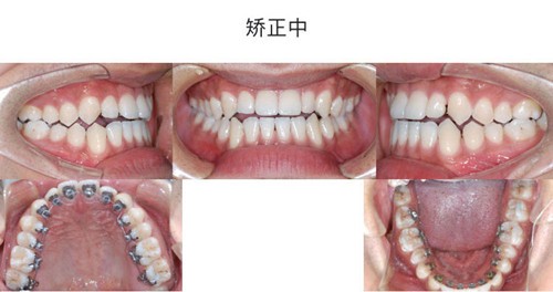 牙齿矫正的价格一般是多少？分享杭州美奥口腔正畸收费标准