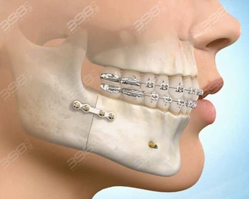牙齿矫正后年老容易牙齿脱落吗