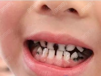 如何预防儿童龋齿
