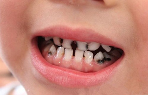 没换牙的孩子龋齿用不用治疗?听听牙医怎么说