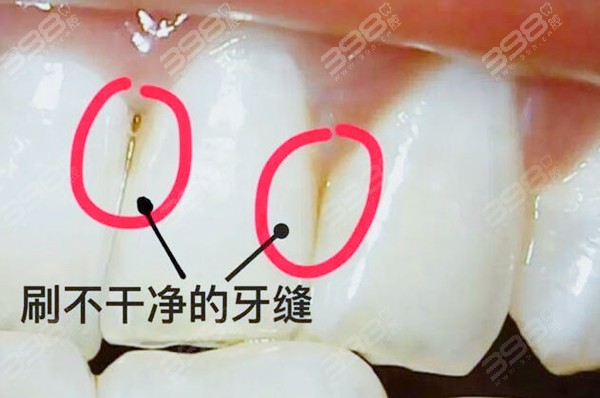 牙缝里臭味怎么清除？