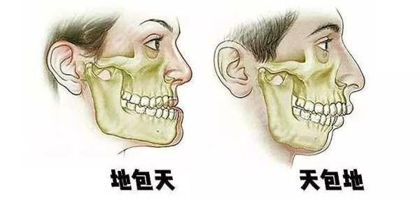 正畸手术和正颌的区别