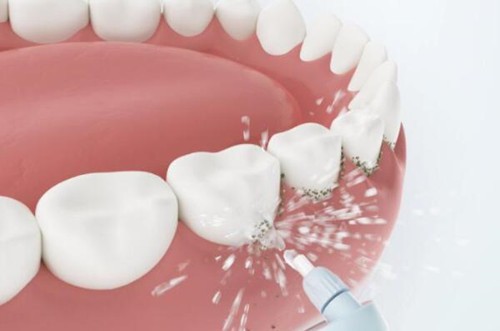 洗牙以后要注意什么 经常洗牙对牙齿好吗