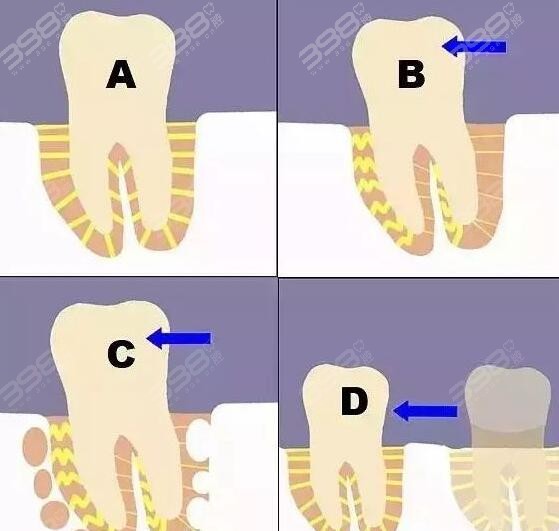 牙齿矫正时牙齿如何移动？