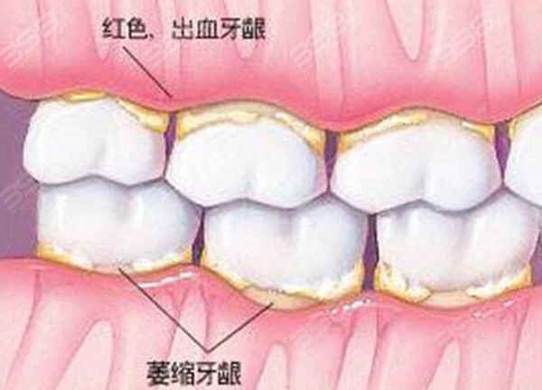 牙龈萎缩导致牙齿敏感