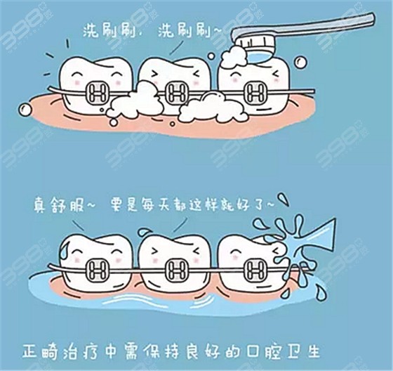 戴牙套期间怎么清洁牙齿，才能在摘牙套时不会脱矿？