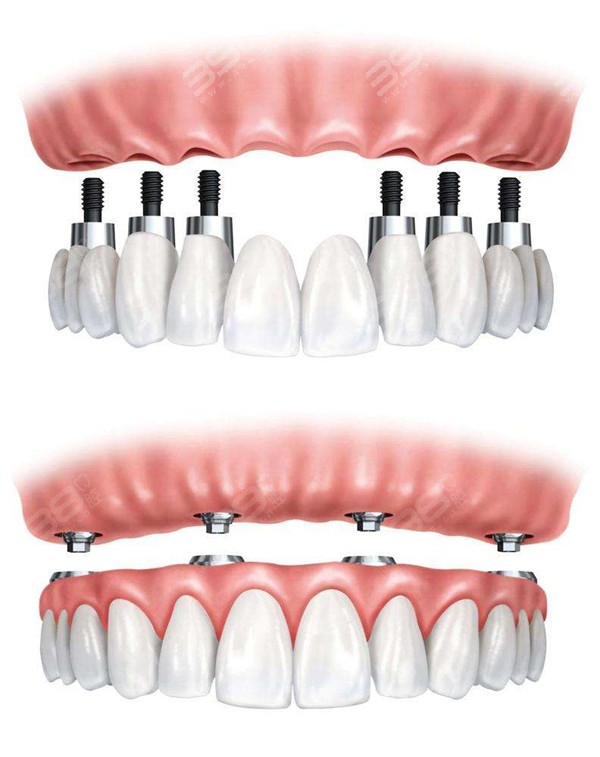 种植牙半固定和全固定的区别